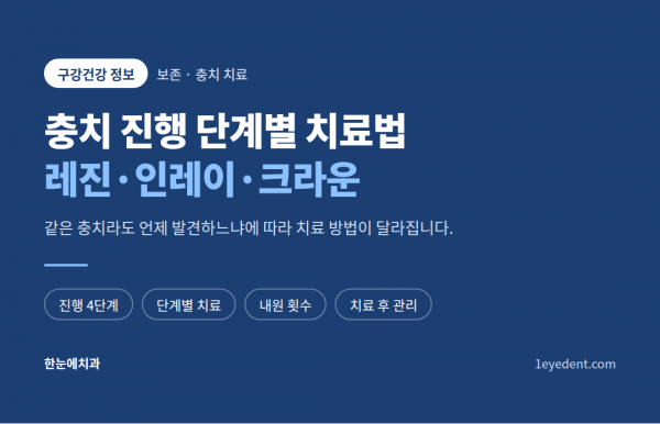 충치 진행 단계별 치료법: 레진·인레이·크라운 (1)