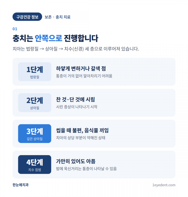 충치 진행 단계별 치료법: 레진·인레이·크라운 (2)