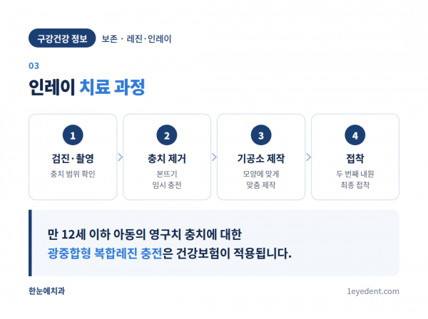 레진과 인레이, 선택 기준은 충치 크기다 (4)